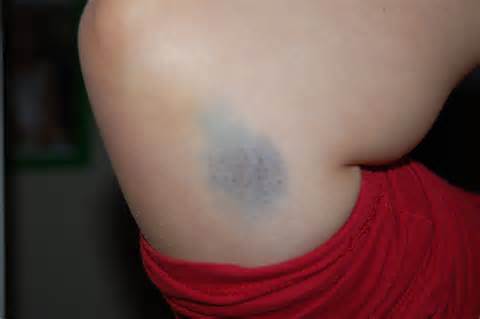 definisyon nan bruise