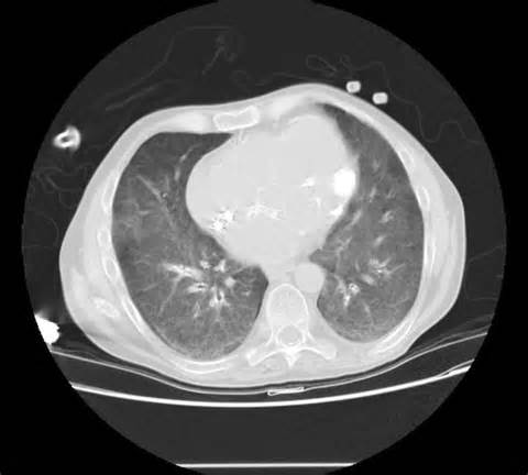 calcification是什么意思