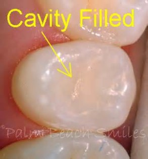 Definitions of cavity