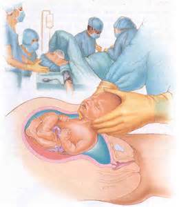Definitions of cesarean