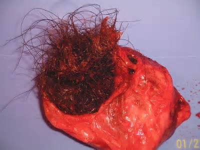 opredelitev dermoid