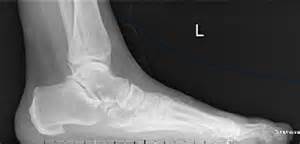 Definitions of hallucal