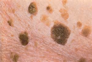 opredelitev keratoses