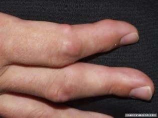 Definitions of tophus