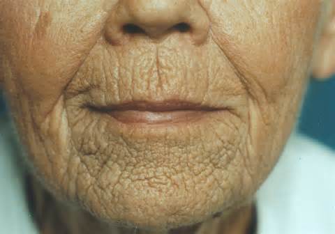 Definice wrinkle