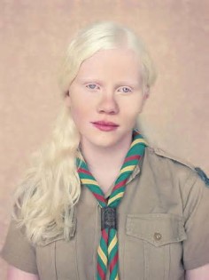 definisyon nan albinisms