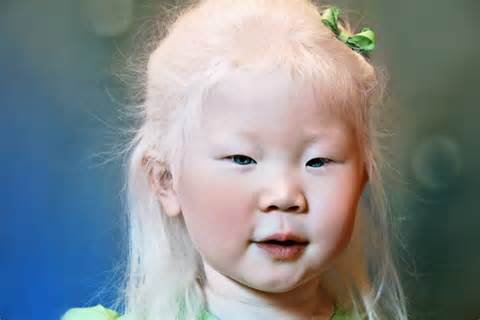 definisyon nan albinisms