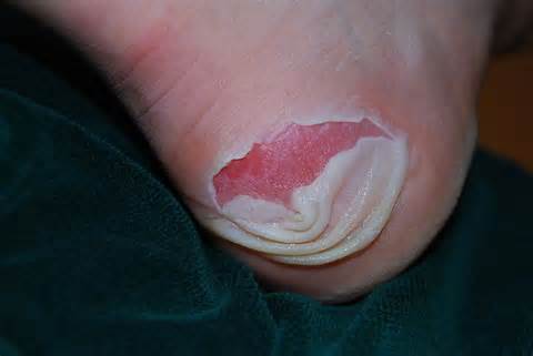 Definitions of blister