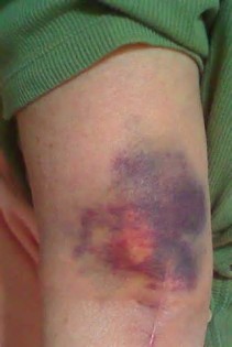 Definice bruising
