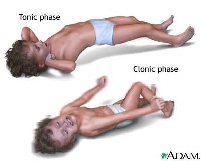 Definition af convulsions