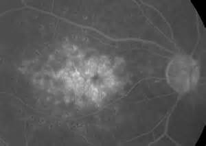 Definice cystoid