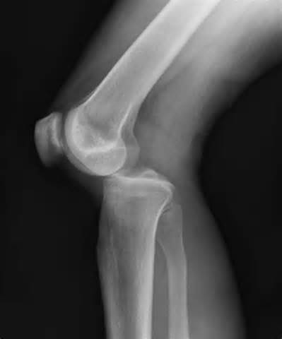 Definitie van dislocation