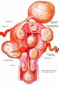 opredelitev fibroids