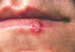 herpes परिभाषा
