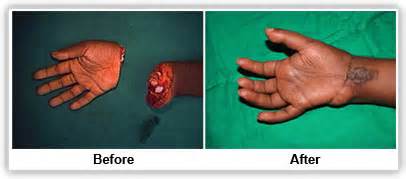 definisyon nan microsurgery