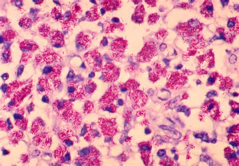 definisyon nan mycobacterium