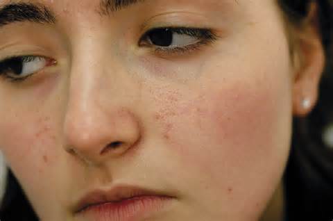 Ορισμός του pimples