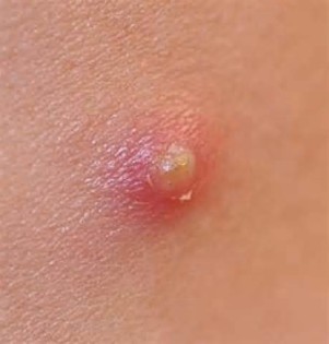 Ορισμός του pimples