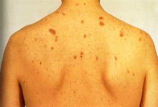 sarcoma کی تعریف