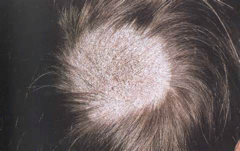 definición de scalp