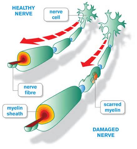Definice sclerosis