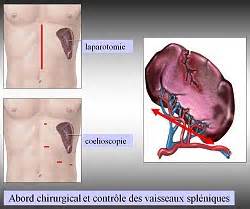 Definice splenectomies