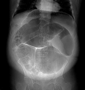 volvulus tanımı