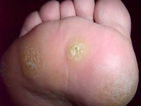 definisyon nan warts