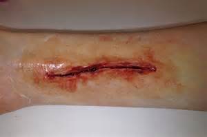 Definicija wound