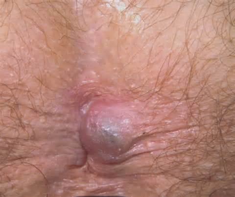definisyon nan anus