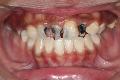 definisyon nan cavities