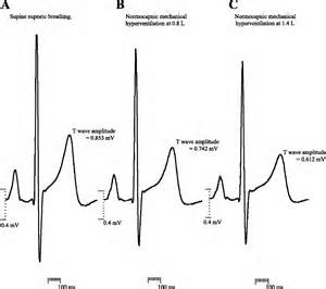 Definitions of eupnea