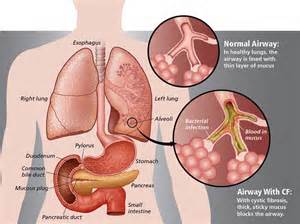 Definitions of fibrosis