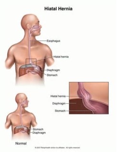 definisyon nan hiatal