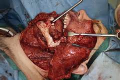 Definitions of resection