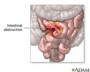 Dieta para obstruccion intestinal