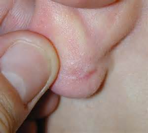definizzjoni ta hypotrophic