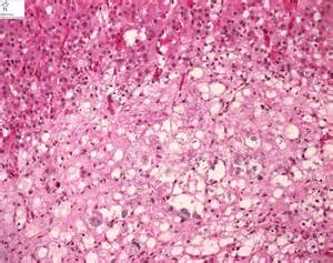 Definice calcifications