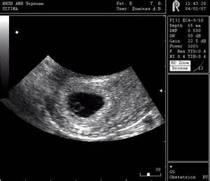 definisyon nan echograms