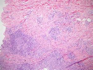 Definition von mycobacterial
